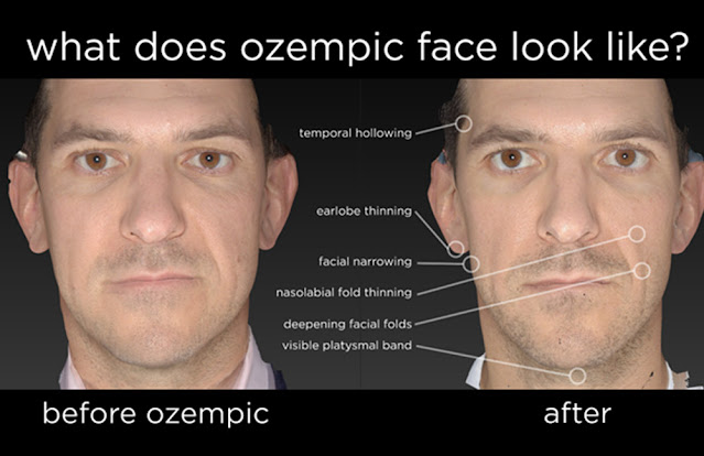 Ozempic Face Secrets Revealed: Unlocking the Glow